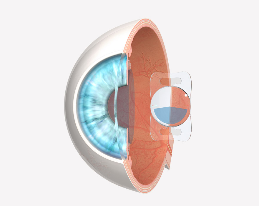 LENTIS Mplus neben Kapselsack