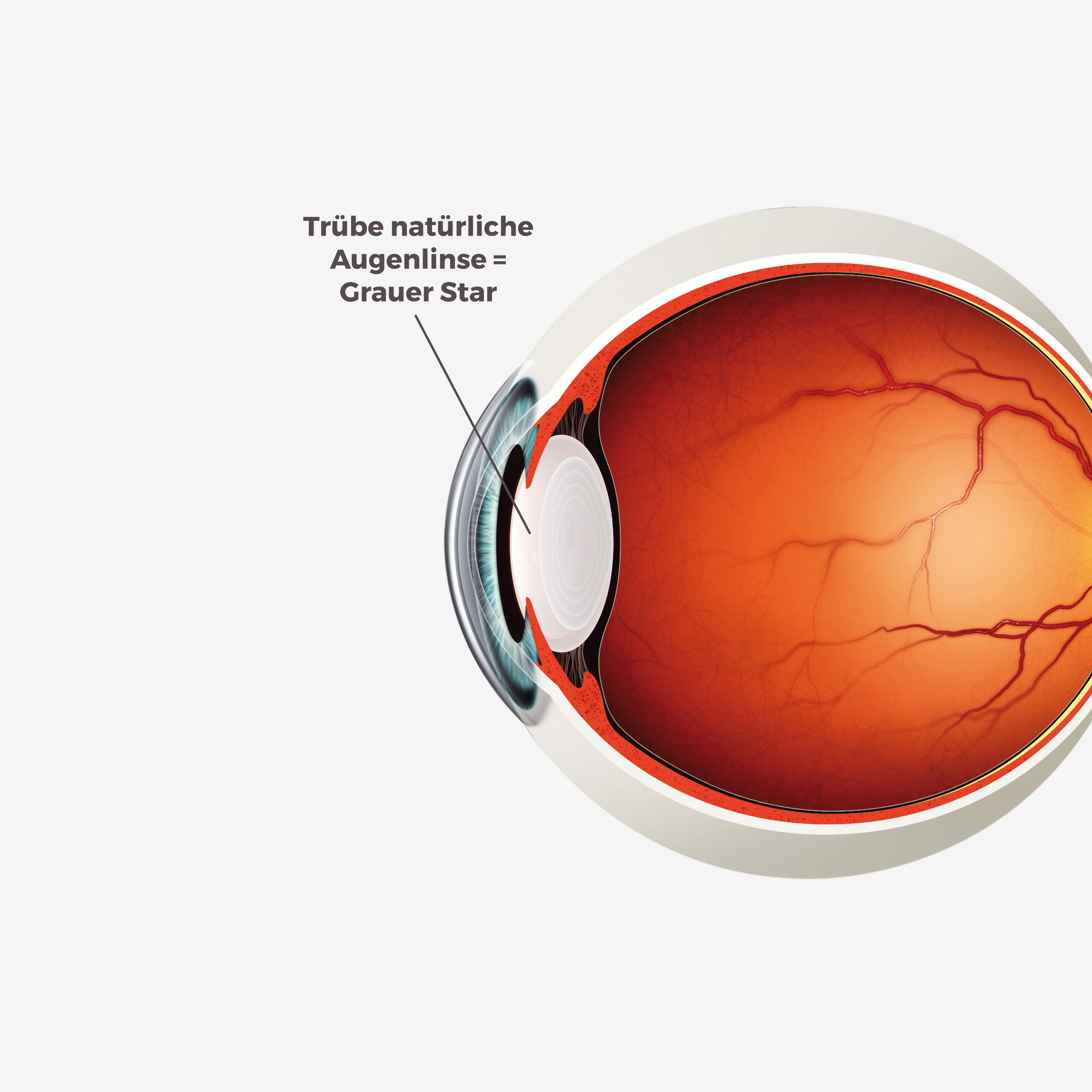 Grauer Star - Augenzentrum Nymphenburger Höfe München