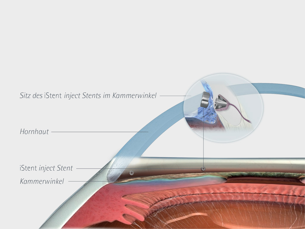 Grüner Star / Glaukom 3 istent inject implantation transparent large
