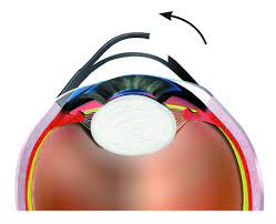 augenlaser fetmo lasik 1