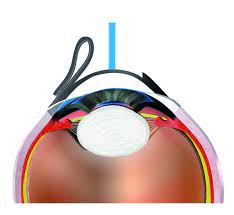 augenlaser fetmo lasik 2