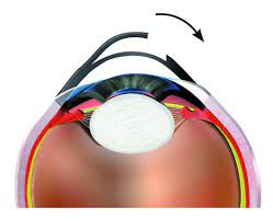 augenlaser fetmo lasik 3